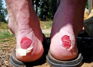 Blister Prevention Blisters